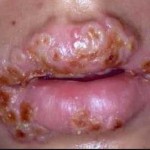 Enfermedades de transmisión sexual que se contagian por la boca