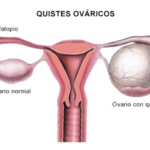 Conoce más de los quistes ovaricos